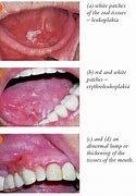 Image result for Oral Cancer On Gums