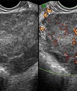 Image result for Dysgerminoma Ultrasound