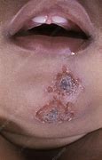 Image result for Impetigo Skin Infection