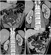 Image result for Renal Sinus Cyst