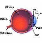 Image result for Cataract Surgery Lenses. Types