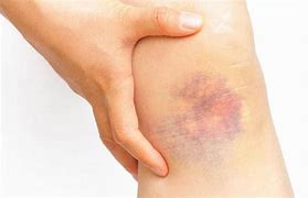 Image result for Bruise