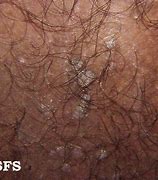 Image result for Genital Wart Male After Treatment