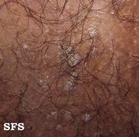 Image result for Genital Wart or Mole