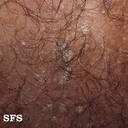 Image result for Genital Wart