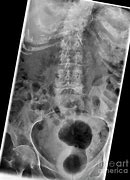 Image result for Vertebral Collapse