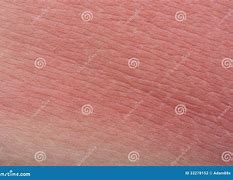 Image result for SunBurn Skin Cancer