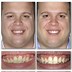 Image result for Invisalign Crowding Before and After