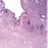 Image result for Verrucous Congenital Nevus Pathology