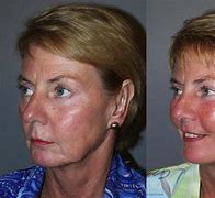 Image result for Facelift and Neck Lift Surgery