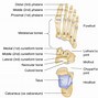 Image result for Acute Jones Fracture