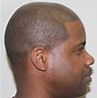 Image result for African American Hair Transplant