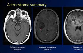 Image result for Astrocitoma