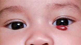 Image result for hemangioma