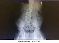Image result for Lower Lumbar Spine