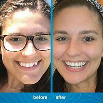 Image result for Invisalign Before and After Pics