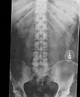 Image result for AP Lumbar Spine