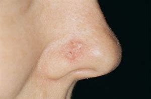 Image result for Bump On Nose Skin Cancer