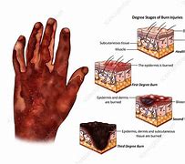 Image result for Burn Wound Stages