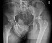 Image result for Pelvic Fracture Treatment