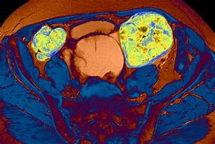 Image result for Ovarian Cancer MRI
