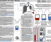 Image result for Chest Tube Cheat Sheet