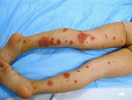 Image result for HSP Rash