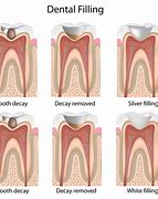 Image result for Dental Restoration Types