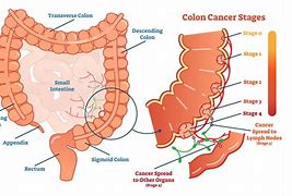 Image result for 10 Cm Tumor in Colon