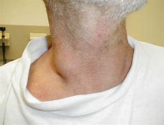 Image result for adenitis