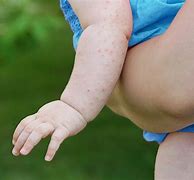 Image result for Viral Rash Toddler