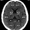 Image result for Frontal Lobe CT