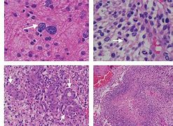 Image result for Malignant Glioma