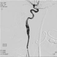 Image result for Right Internal Carotid Artery