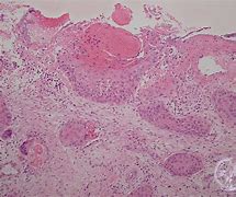 Image result for Invasive Squamous Cell Carcinoma