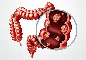 Image result for Intestinal Tumor