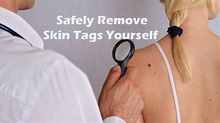 Image result for Cutting Off Skin Tags