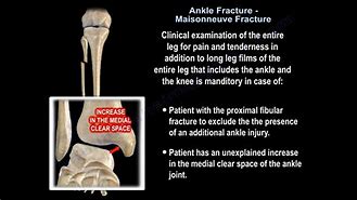 Image result for Maisonneuve Fracture Ankle