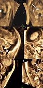 Image result for Choroid Plexus Fetal Ultrasound