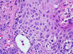 Image result for Early Squamous Cell Skin Cancer