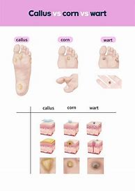 Image result for Foot Warts Treatment