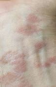 Image result for Allergic Eczema Symptoms