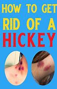 Image result for How to Get Rid of a Hickey Fast Cocoa Butter