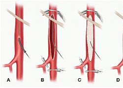 Image result for Femoral Artery Endarterectomy