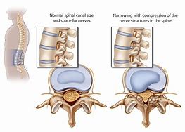 Image result for Spine Anatomy Spinal Stenosis