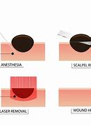 Image result for Mole Removal Procedure