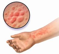 Image result for Skin Rash