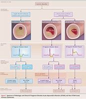 Image result for 5 Types of Myocardial Infarction