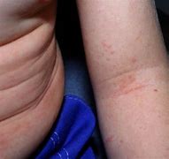 Image result for What Is Scarlet Fever