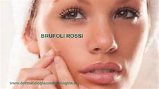 curare l acne dall interno brufoli dolorosi quali rimedi curare l acne dall interno brufoli dolorosi quali rimedi